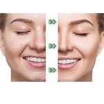 VIMEDA | Green Tea Mask™ (1+1 GRATIS)