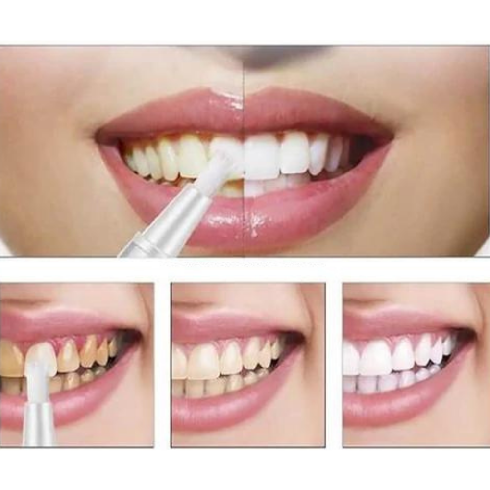 VIMEDA | Teeth Whitening Pen™ (1+1 GRATIS)